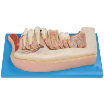 LOWER JAW OF 12-YEAR-OLD